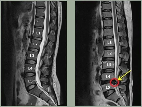 Hình ảnh đường cong cột sống thay đổi trong bệnh thoát vị đĩa đệm vùng cột sống thắt lưng. Ảnh: BSCC