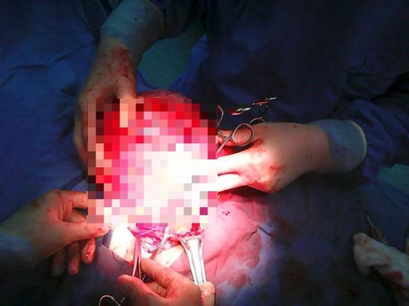 cắt khối u khủng