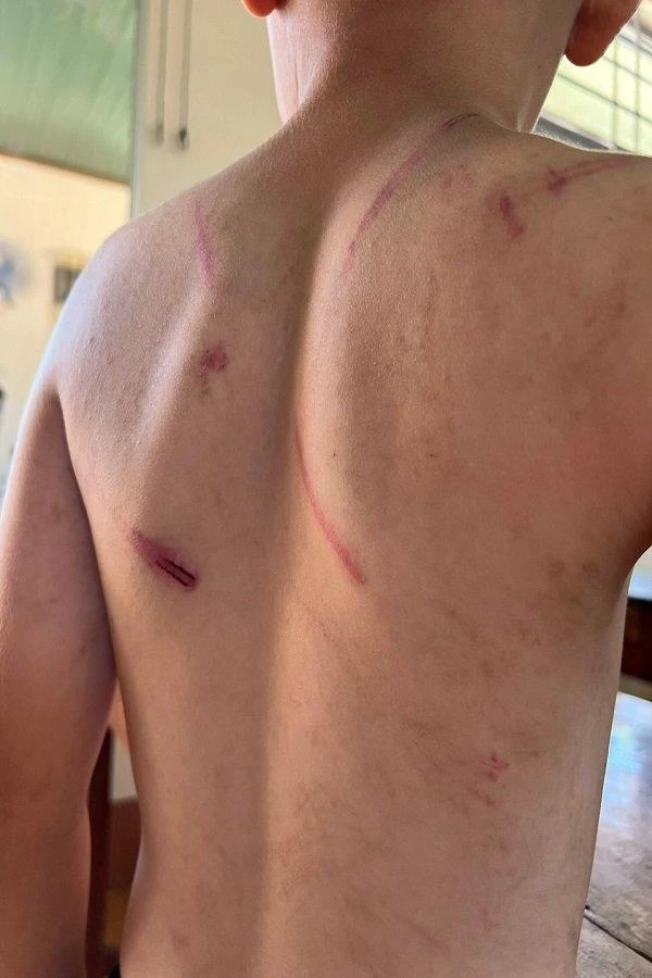 Trên cơ thể cháu A. có nhiều vết thương được cho là do cha và bà nội đánh. Ảnh: Gia đình cung cấp