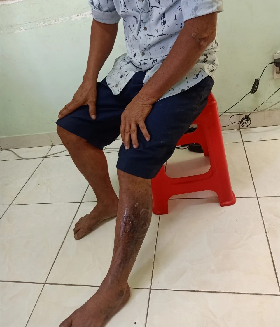 Người đàn ông bị lửa làm bỏng nhẹ. Ảnh: CACC