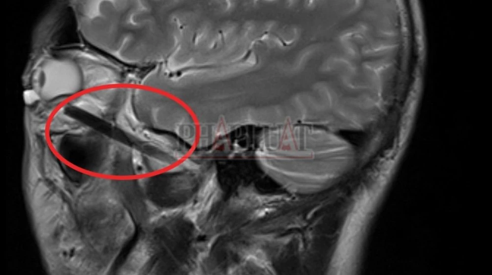 chiếc đũa đâm sâu trong hốc mắt (3).jpg