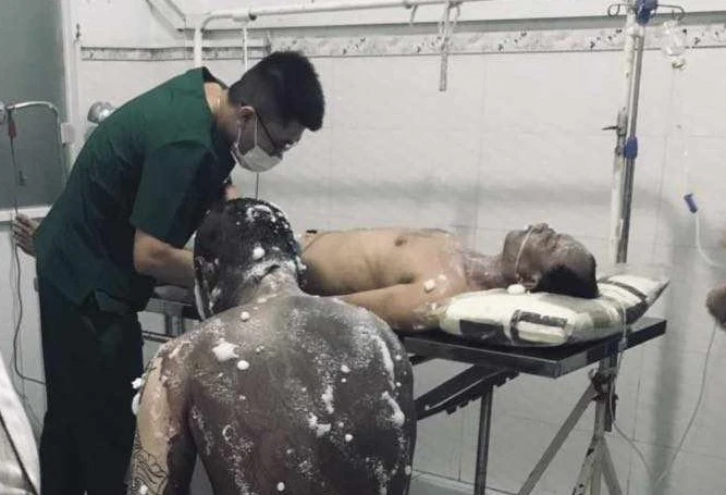 công nhân bị bỏng (2).jpg