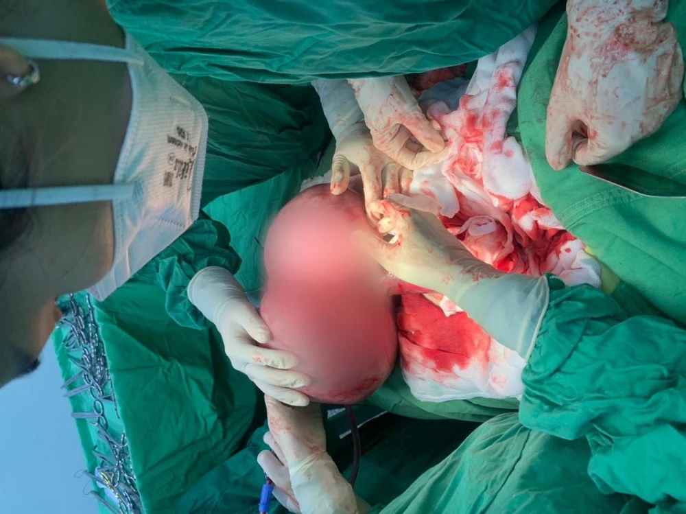 Các bác sĩ mổ lấy khối u nặng 5,5kg trong tử cung phụ nữ. Ảnh: BVCC