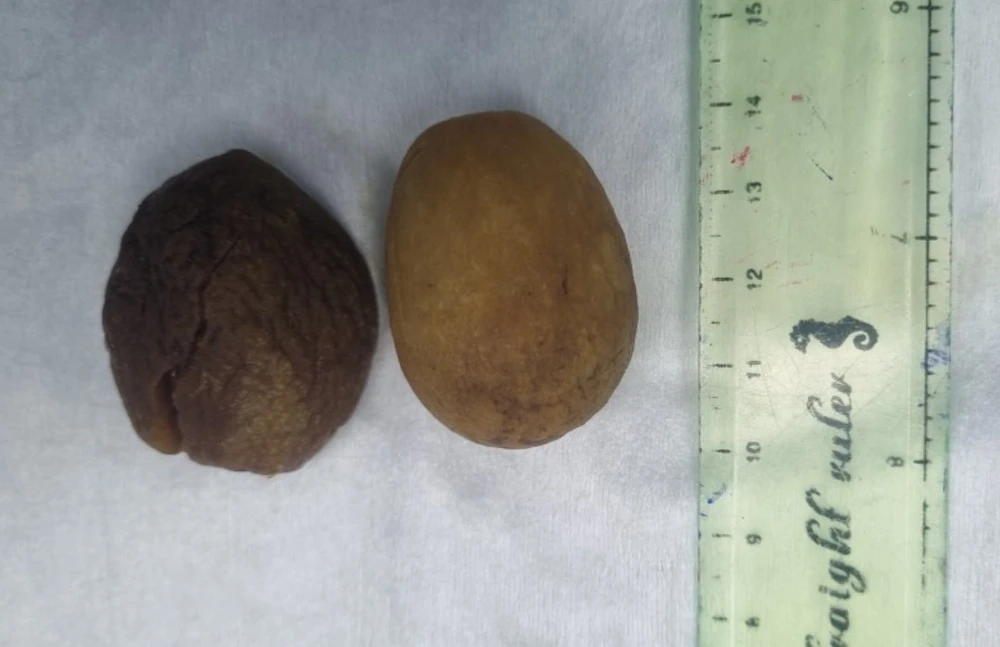 tắc ruột tắc ruột