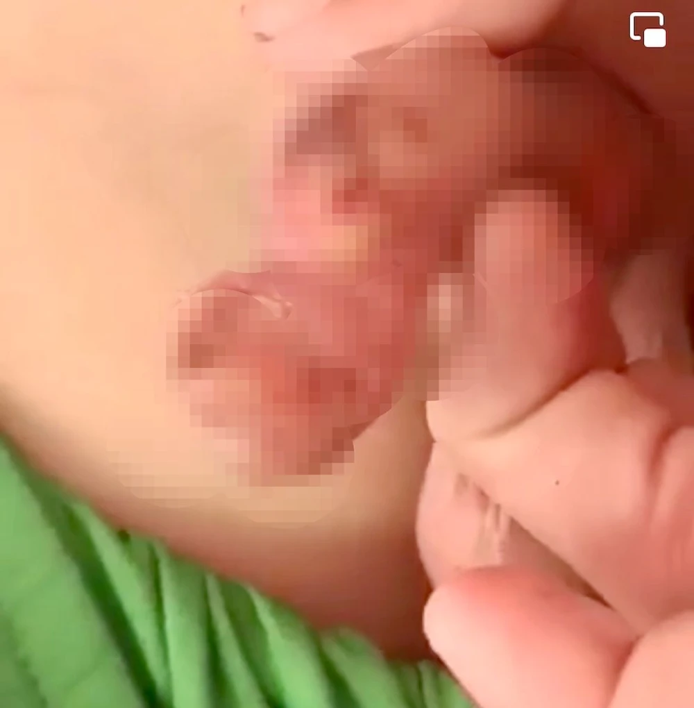 đốt bộ phậm sinh dục