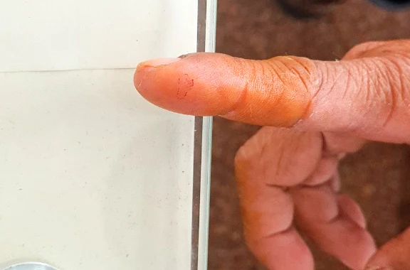 nhện độc cắn chảy máu