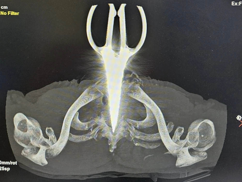 kéo đâm xuyên cổ người đàn ông