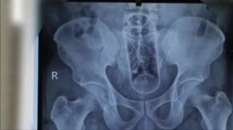 Ảnh chụp chai nhựa dài khoảng 20cm nằm trong hậu môn trực tràng người đàn ông