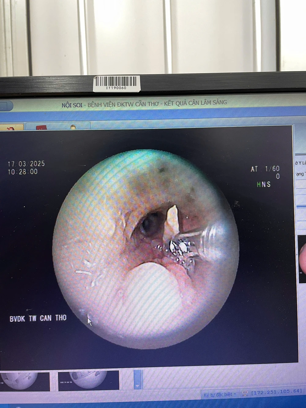 Mảnh xương vịt mắc trong phổi