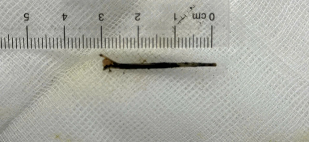 xương cá xuyên dạ dày,cần thơ