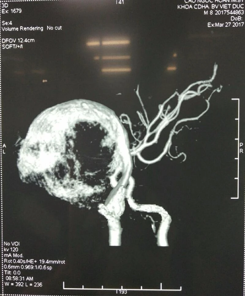 Hình ảnh phình động mạch cảnh trong khổng lồ của bệnh nhân.