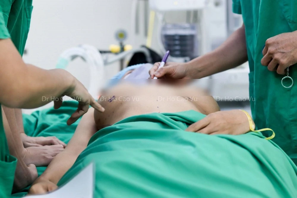 Bác sĩ đo vẽ trước phẫu thuật tháo túi ngực, chỉnh ngực bị thông khe