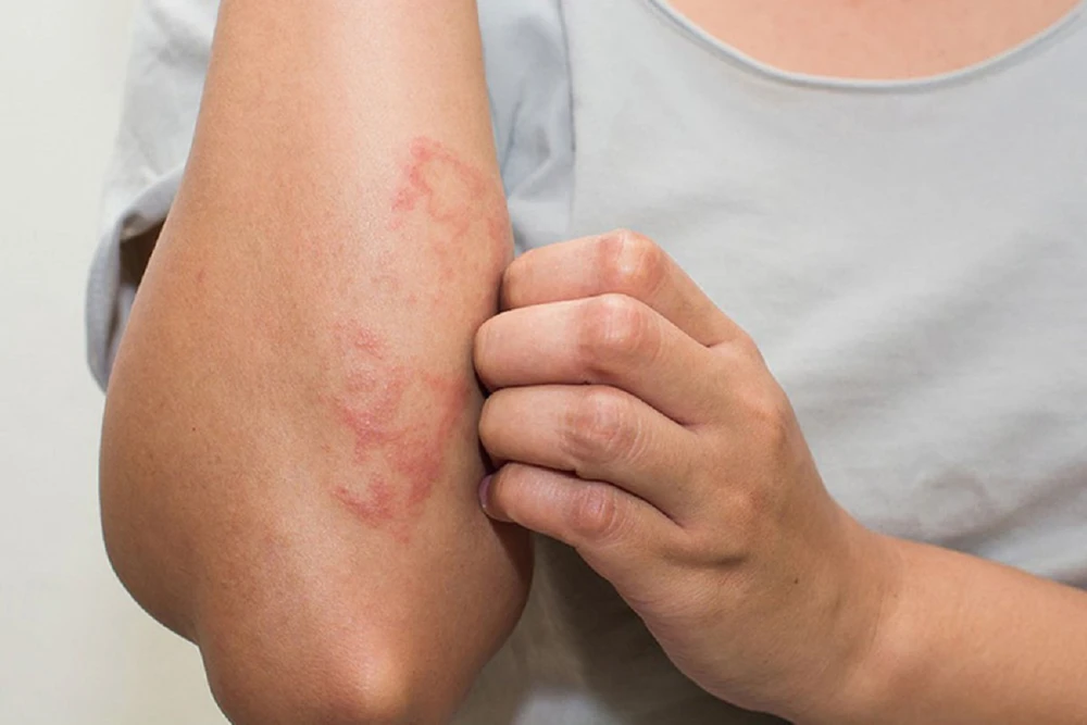 Hạn chế tiếp xúc nước mưa để phòng ngừa viêm da tiếp xúc