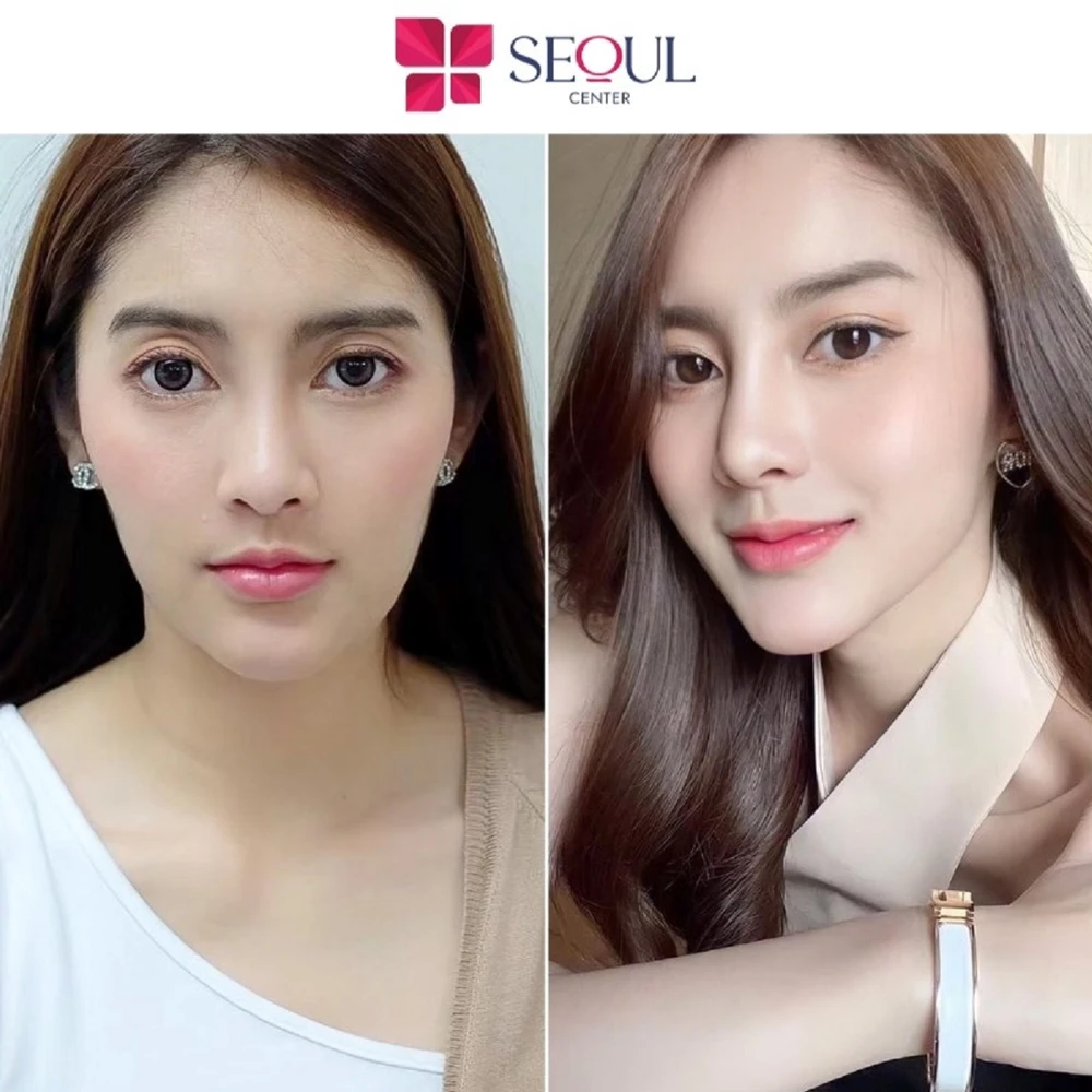 Seoul Center là địa chỉ tiêm filler an toàn và uy tín