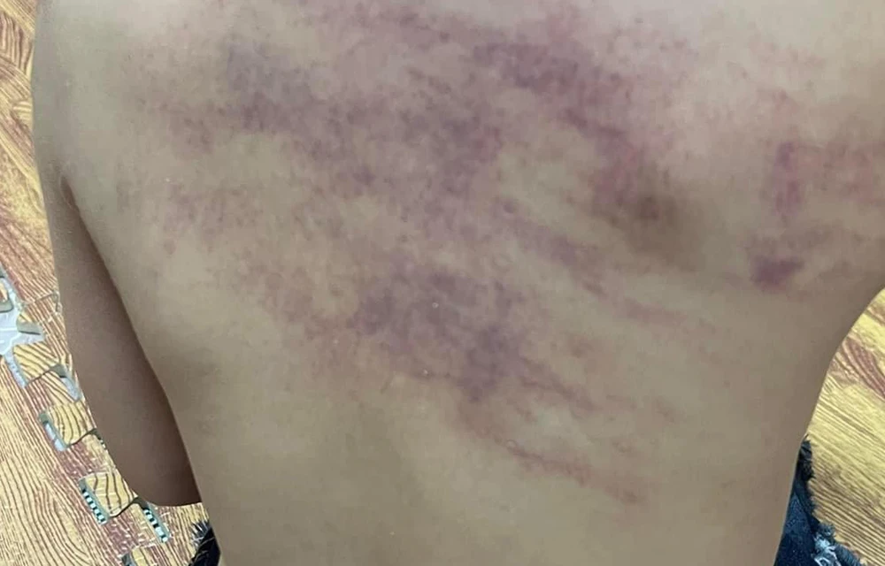 cháu bé nghi bị bạo hành.jpeg