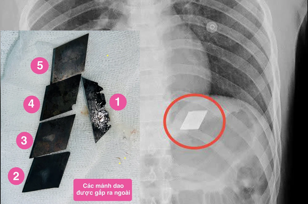 bệnh nhân nuốt dao lam vào bụng.jpg