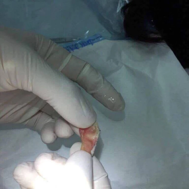 Mảnh tai bị cắn