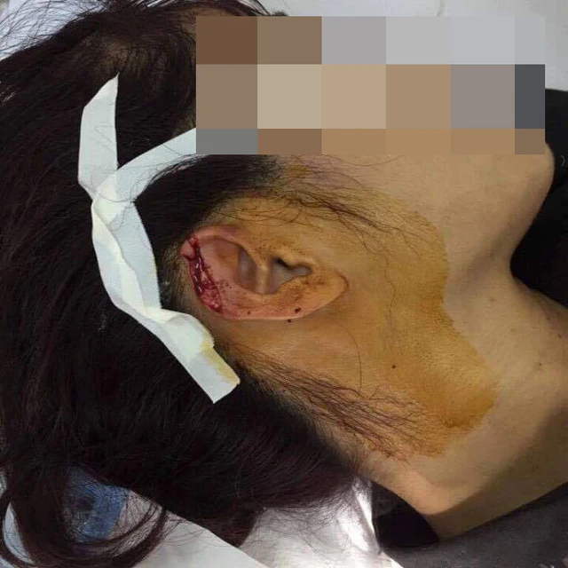 Vết tai bị cắn của cô T