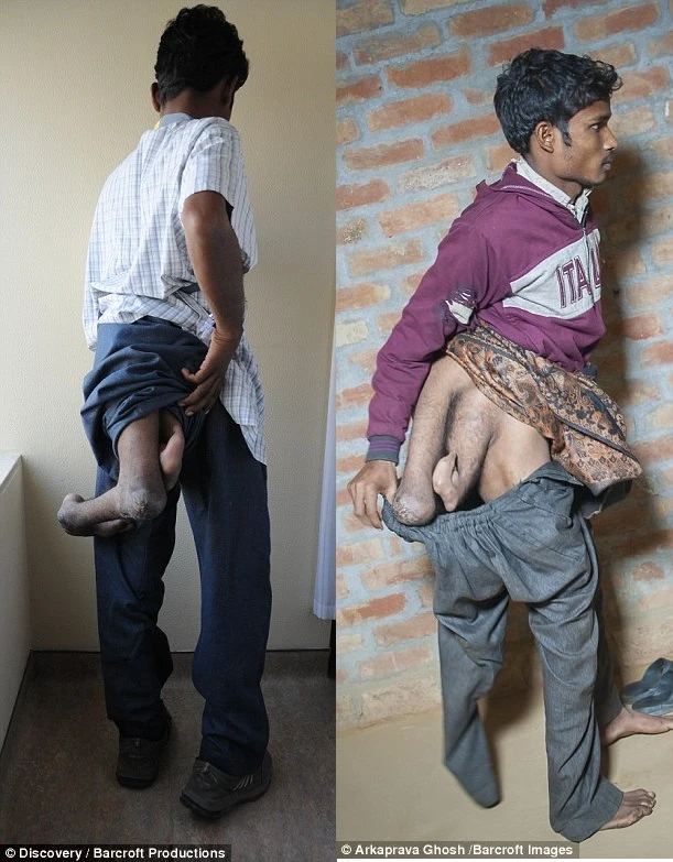 chàng trai ấn độ có 4 chân