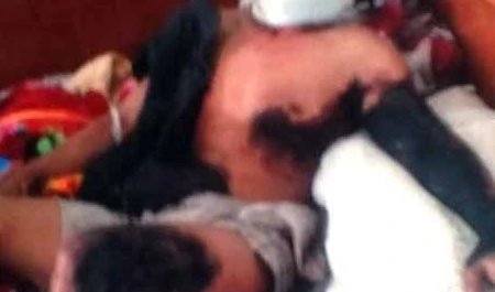 Anh Vinh bị cháy sém nửa người nhưng không được đưa đến bệnh viện cấp cứu kịp thời vì kinh tế khó khăn.