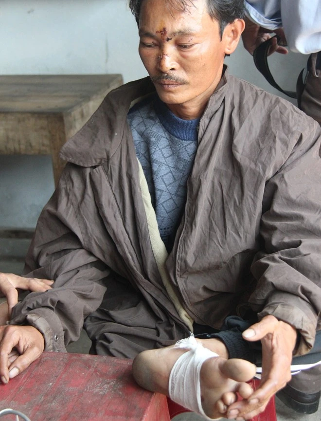 Anh Võ Tương bị thương ở mặt và chân.