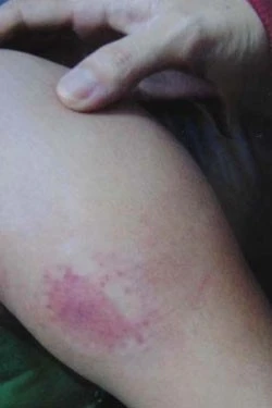 Một dấu vết trên người em vợ nghi bị Thọ xâm hại. 