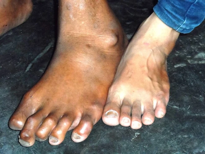Bàn chân ông Chính vượt trội so với người thường