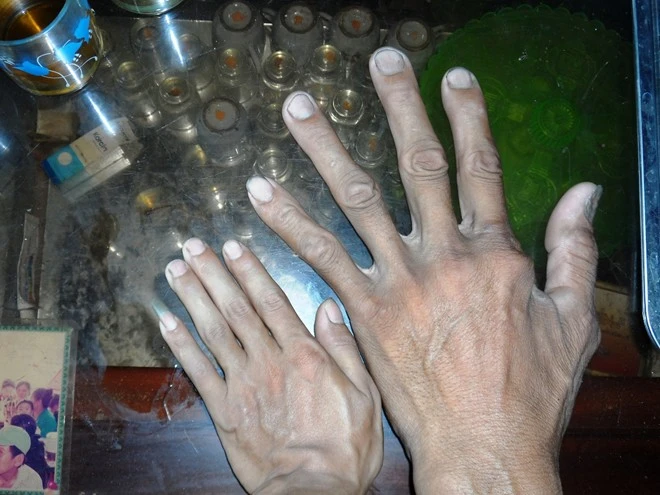 Bàn tay ông Chính to gấp đôi người bình thường