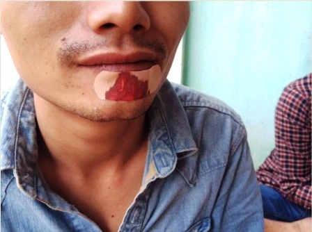 Anh Thuận bị đánh vào mặt, có vết rách hàm dưới xuyên vào miệng