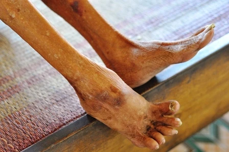 &nbsp;Đôi chân của cụ Ngôn bị bệnh tật hành hạ, co quắp đau đớn