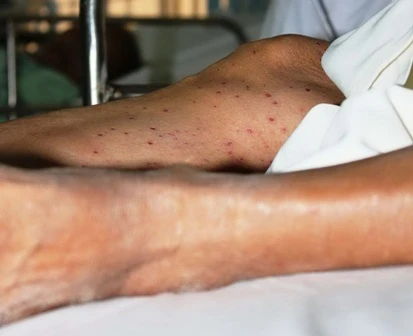 Nhiều vết thương do côn trùng đốt trên cơ thể bà Mai.