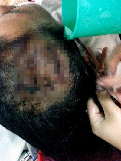 Bà Dư phải khâu 62 mũi trên đầu.