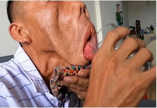 Bác sĩ Tú Dung đã giải cứu anh Mến khỏi gương mặt biến dạng suốt 15 năm.png