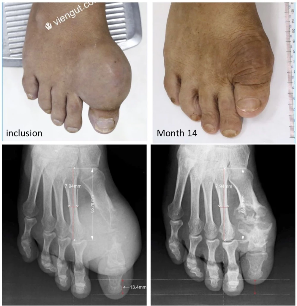 Hình ảnh điều trị tan tophi của Viện Gút được công bố tại Hội nghị thường niên Hội Thấp khợp học Mỹ (ACR) 2020.png