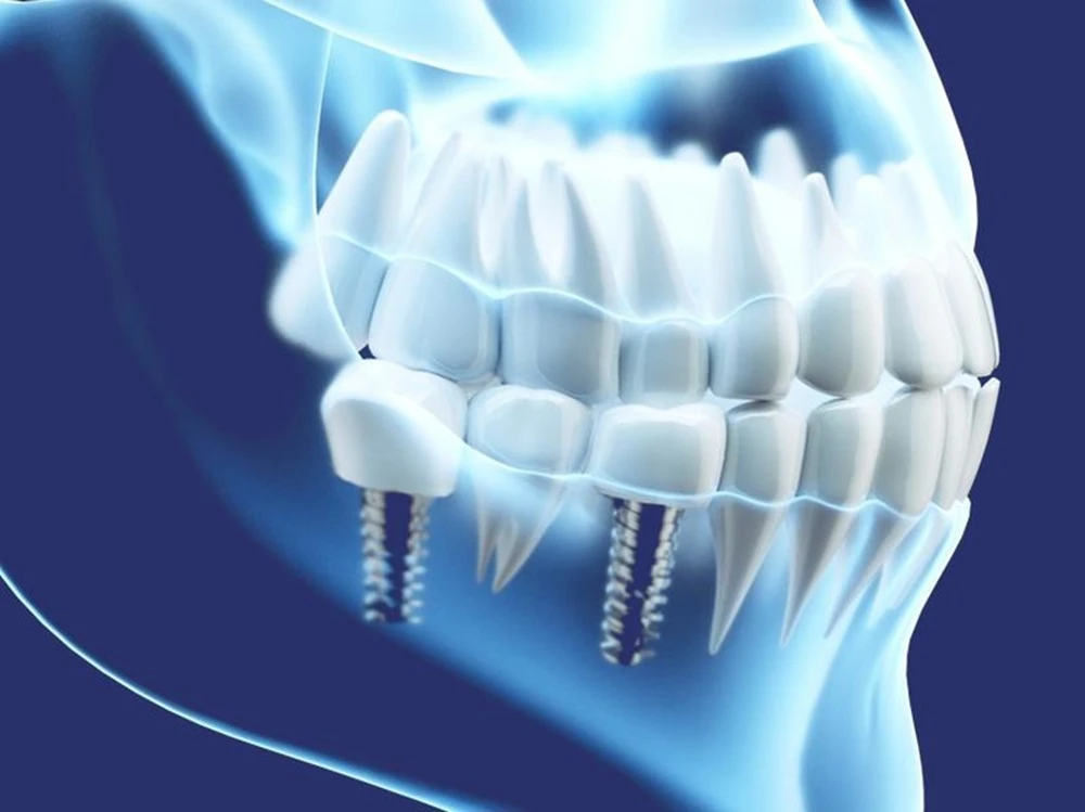 Ứng dụng công nghệ trồng răng không đau Pro-Implant tại Nha khoa Flora.jpg