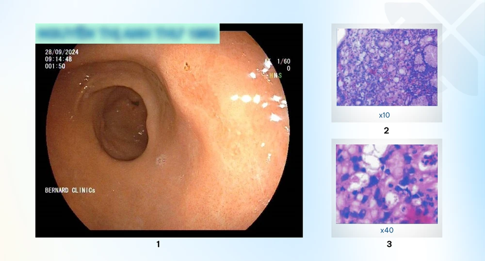 Nhiều trường hợp phát hiện sớm tổn thương tiền ung thư qua nội soi tiêu hóa tại Bernard.png