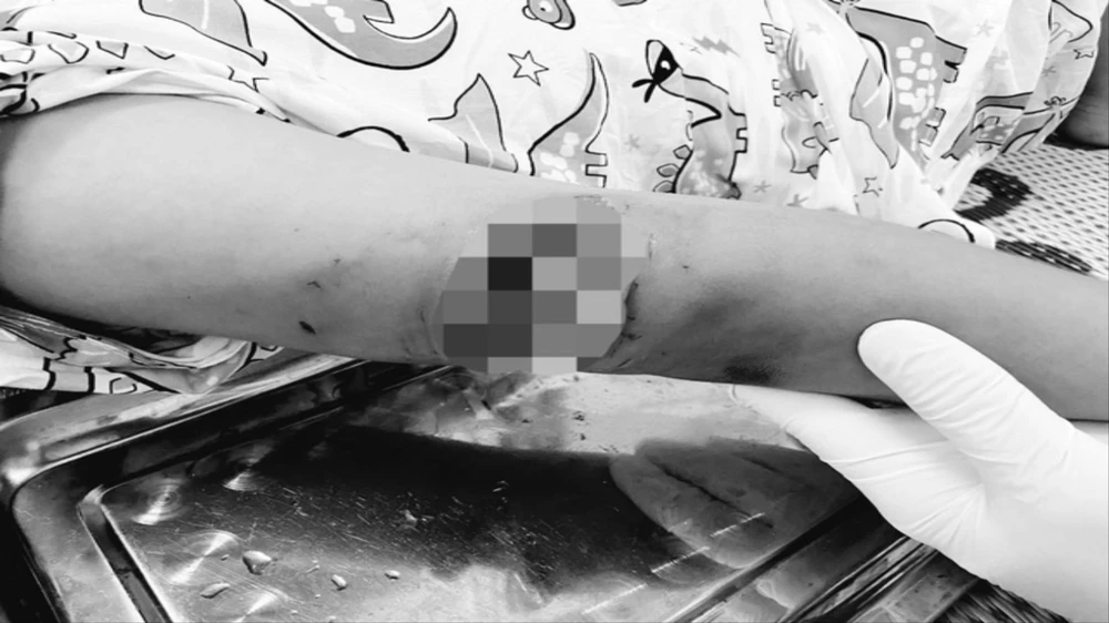 Bé gái bị chó cắn