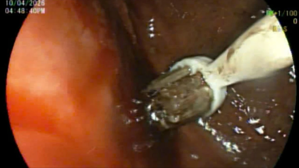 nam-thanh-nien-nuot-3-ban-chai-danh-rang-vao-bung (1).jpg