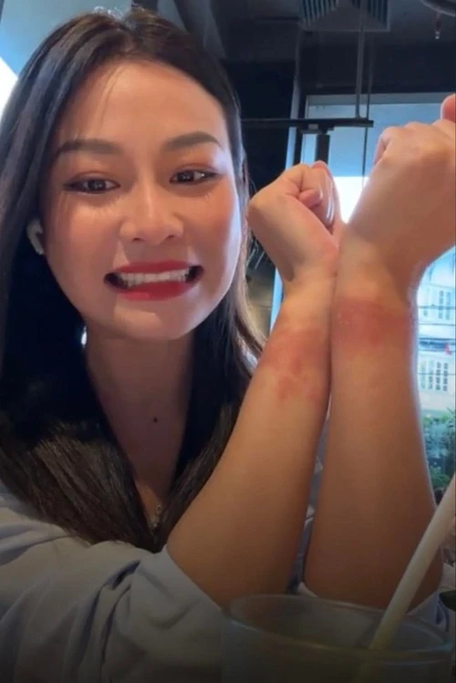 Quỳnh Châu "khoe" vết bầm trên sóng livestream khi tham gia quay phim. Ảnh: Chụp màn hình