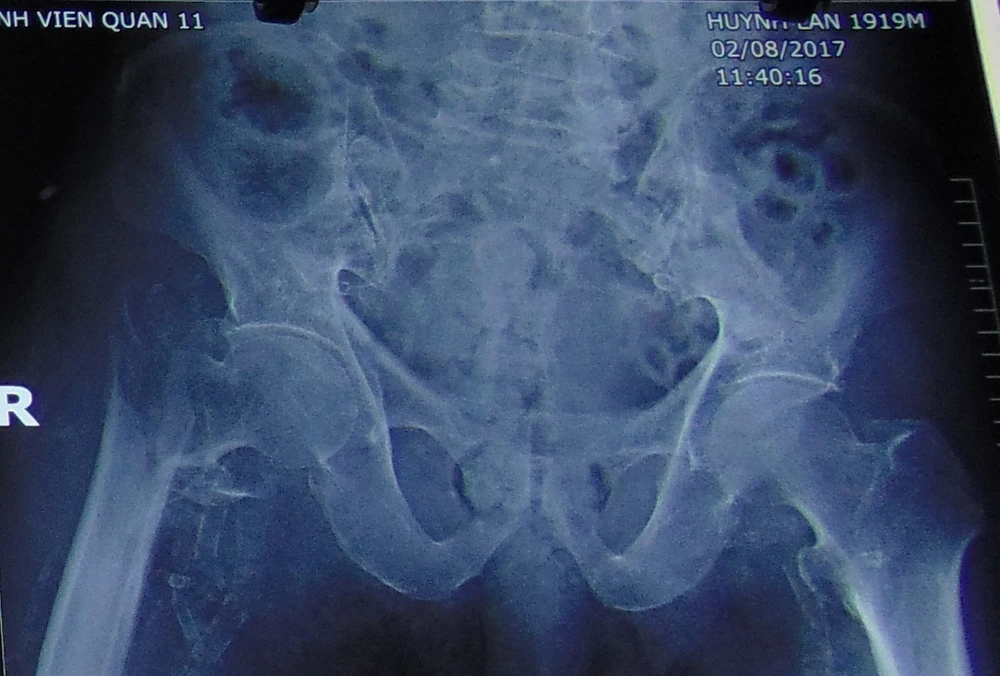 Kết quả chụp X quang cho thấy ông L bị gãy khớp háng chân phải. Ảnh: TRẦN NGỌC