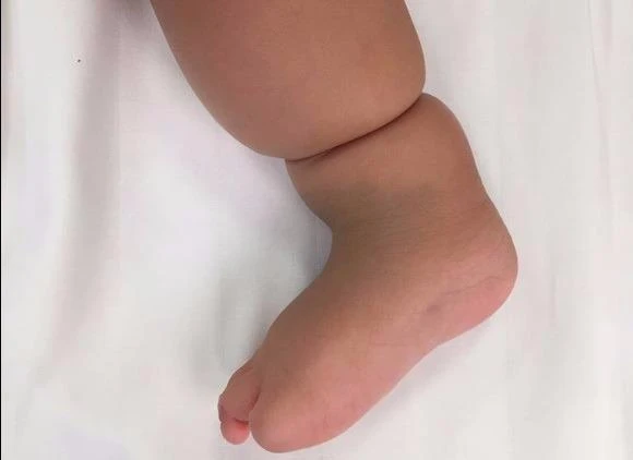 Chân phải con bà H. bị vòng thắt nên mất ngón cái và ngón út.