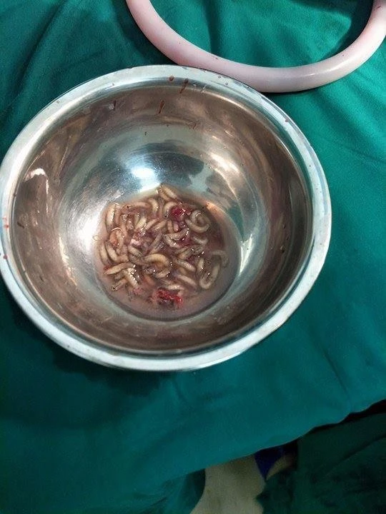 Ấu trùng được lấy ra từ cánh tay của ông K.