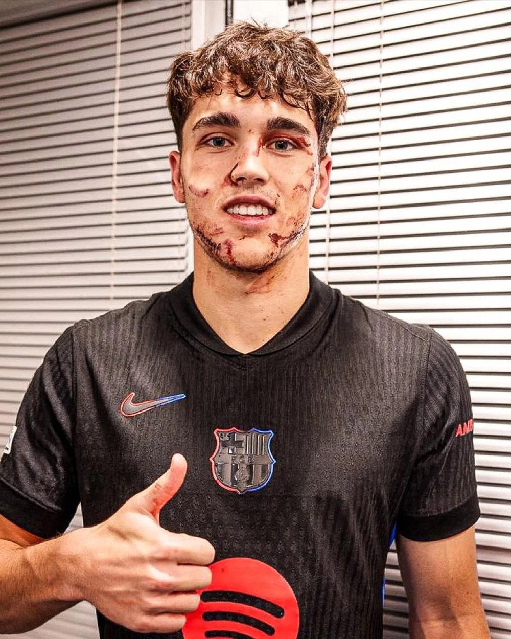 hậu vệ Barca khâu 10 mũi