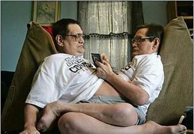 Những cặp song sinh dính liền vẫn sống tốt ảnh 3