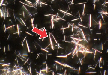 Tầm soát miễn phí bệnh gút trong cộng đồng ảnh 1 Tầm soát miễn phí bệnh gút trong cộng đồng ảnh 1