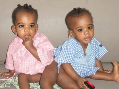 Tách thành công cặp song sinh dính liền xương sống ảnh 3