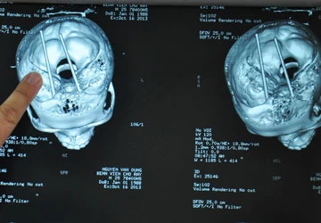 Báo động chuyện đâm đũa vào mắt ảnh 1