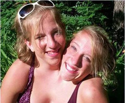 Những cặp song sinh dính liền vẫn sống tốt ảnh 5