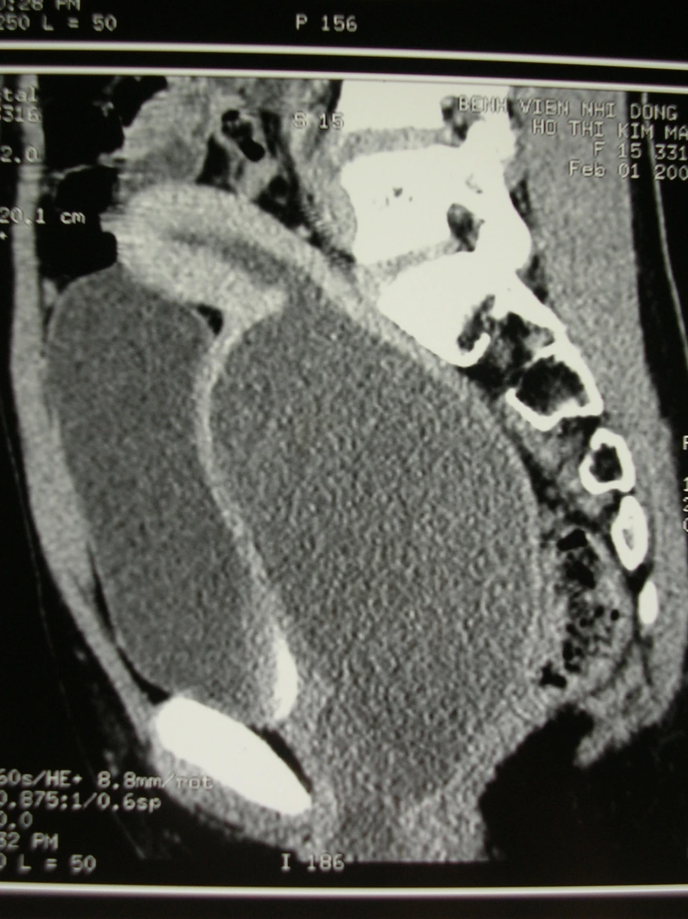 Tạo hình âm đạo cho một bé gái 13 tuổi ảnh 1