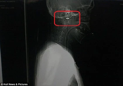 Thoát chết thần kỳ khi bị bắn mũi tên dài 20 cm thẳng vào mặt ảnh 1